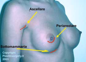 Incisione additiva