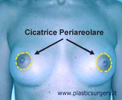 Cicatrice periareolare