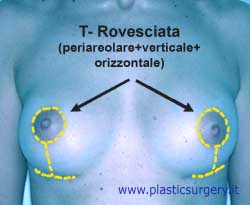 T-rovesciata