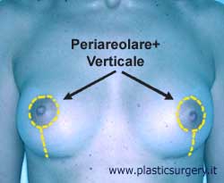 Cicatrice periareolare verticale