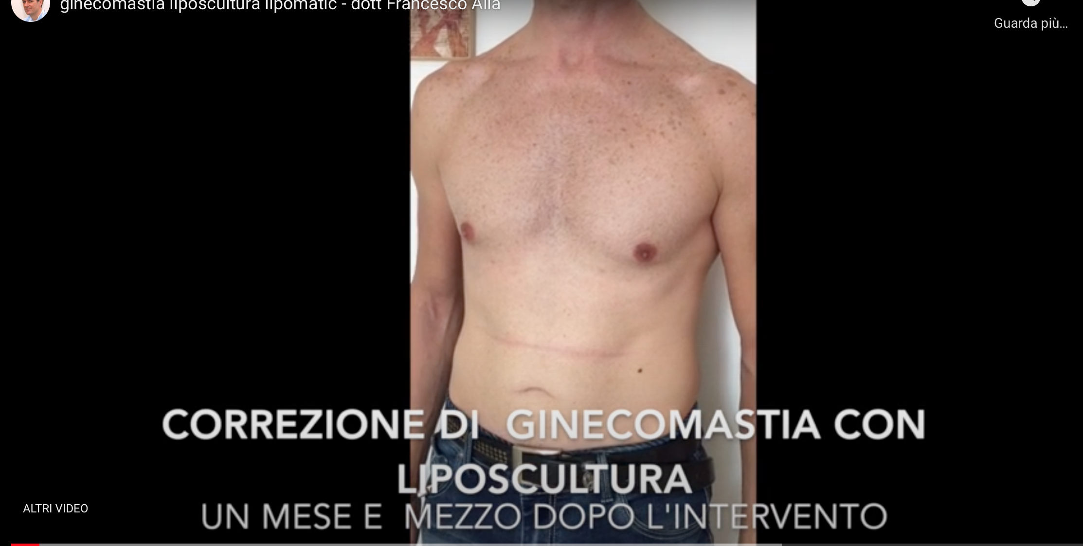 Ginecomastia risultato a un mese